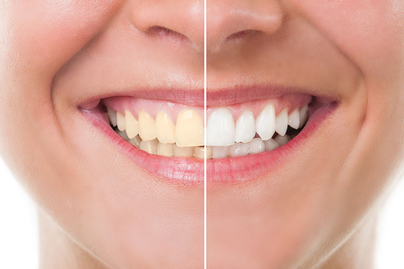 Teeth Whitening - Ian Hamel DDS INC, Burbank Dentist